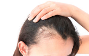 Salon-M Hair Salon & Trichology Clinic In Wallasey, The Wirral Offers Treatments For Coronavirus Hair Loss